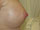 Nipple Surgery