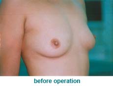 plastic-surgery-breast-augmentation 