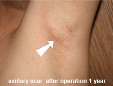 plastic-surgery-breast-augmentation 