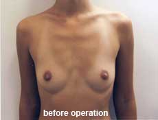 plastic-surgery-breast-augmentation 