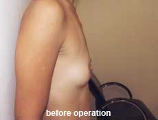 plastic-surgery-breast-augmentation 