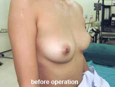 plastic-surgery-breast-augmentation 