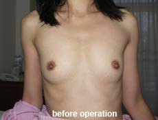 plastic-surgery-breast-augmentation 