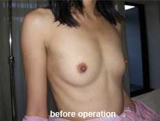 plastic-surgery-breast-augmentation 