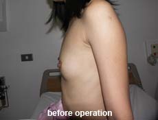 plastic-surgery-breast-augmentation 