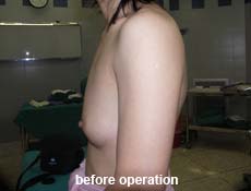 plastic-surgery-breast-augmentation 