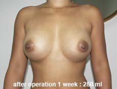 plastic-surgery-breast-augmentation 