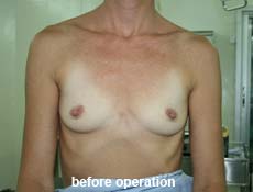 plastic-surgery-breast-augmentation 