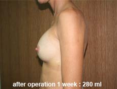 plastic-surgery-breast-augmentation 