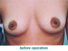 plastic-surgery-breast-augmentation
