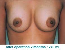 plastic-surgery-breast-augmentation 