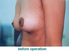 plastic-surgery-breast-augmentation 