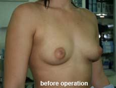 plastic-surgery-breast-augmentation 