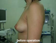plastic-surgery-breast-augmentation 