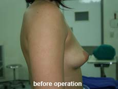 plastic-surgery-breast-augmentation
