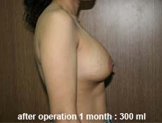 plastic-surgery-breast-augmentation