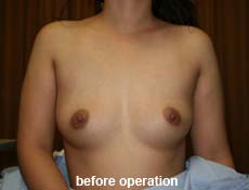 plastic-surgery-breast-augmentation