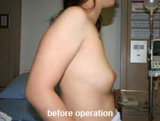 plastic-surgery-breast-augmentation