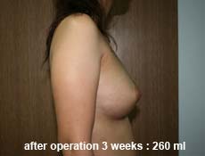 plastic-surgery-breast-augmentation