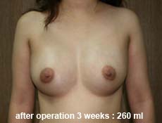 plastic-surgery-breast-augmentation