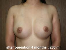 plastic-surgery-breast-augmentation