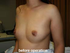 plastic-surgery-breast-augmentation