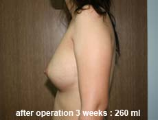 plastic-surgery-breast-augmentation