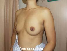 plastic-surgery-breast-augmentation