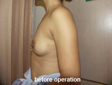 plastic-surgery-breast-augmentation