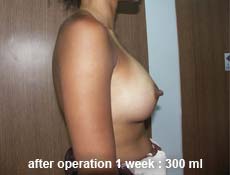 plastic-surgery-breast-augmentation