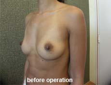 plastic-surgery-breast-augmentation