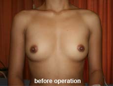 plastic-surgery-breast-augmentation