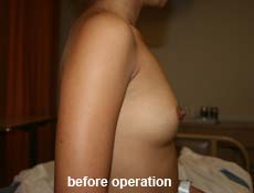 plastic-surgery-breast-augmentation