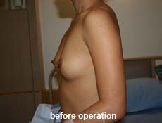 plastic-surgery-breast-augmentation