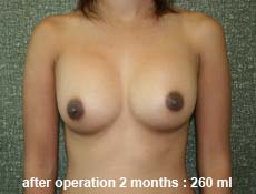 plastic-surgery-breast-augmentation