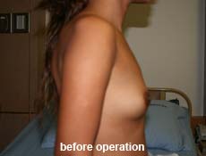 plastic-surgery-breast-augmentation