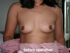 plastic-surgery-breast-augmentation