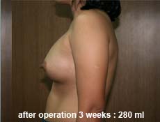 plastic-surgery-breast-augmentation 