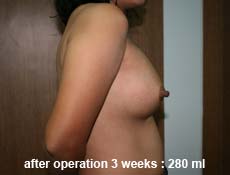 plastic-surgery-breast-augmentation 