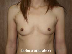 plastic-surgery-breast-augmentation 