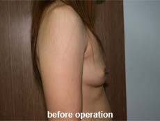 plastic-surgery-breast-augmentation 