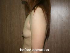 plastic-surgery-breast-augmentation 