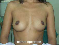 plastic-surgery-breast-augmentation 
