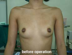 plastic-surgery-breast-augmentation 