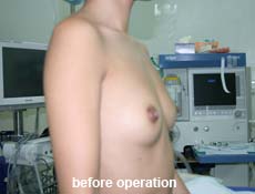 plastic-surgery-breast-augmentation 