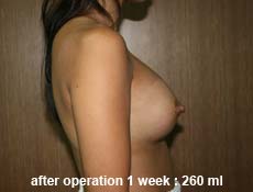 plastic-surgery-breast-augmentation 