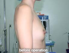plastic-surgery-breast-augmentation 