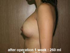 plastic-surgery-breast-augmentation 