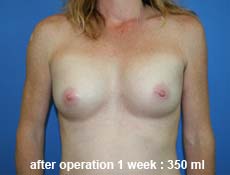 plastic-surgery-breast-augmentation 