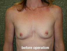 plastic-surgery-breast-augmentation 